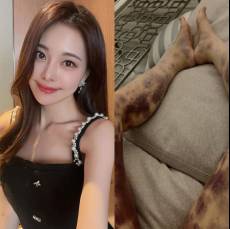 [왓IS] 아옳이, 피부과 시술 후 전신 피멍... 13억 소송 ‘승소’