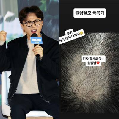 박성광, 원형탈모 극복 中... “감사해요 원장님” 울컥