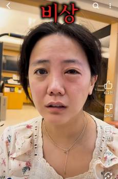 고은아, 한쪽 눈이 퉁퉁 부어...조카가 범인?