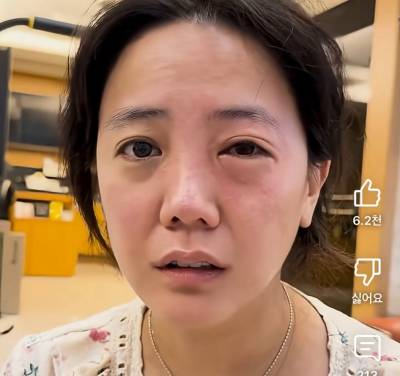 고은아, 한쪽 눈이 퉁퉁 부어...조카가 범인?